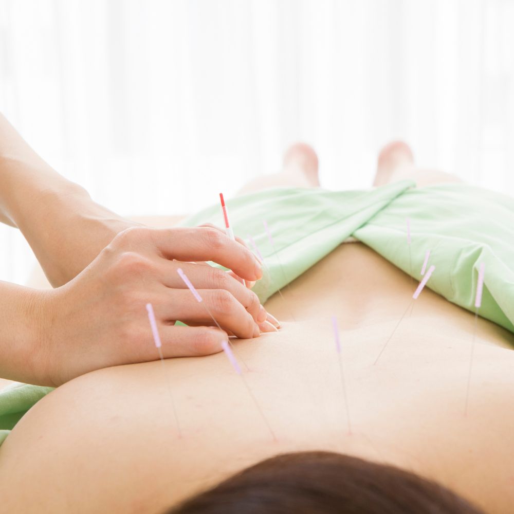 an acupuncture treatment for back pain